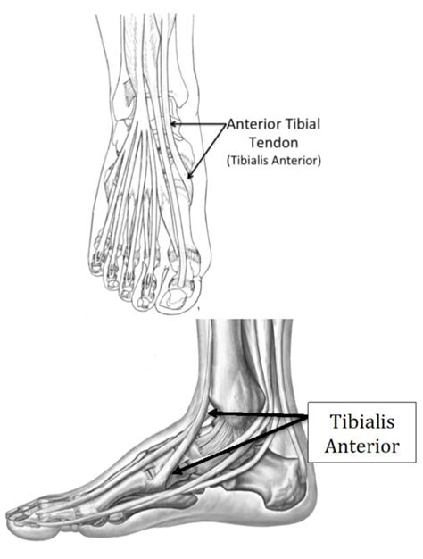 Tibialis Anterior Tendon Disorders Dr Hamish Curry Foot And Ankle Surgeon