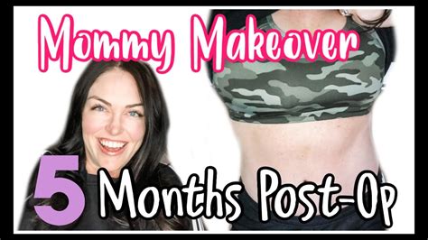 Mommy Makeover Recovery 5 Month Update Tummy Tuck Journeyscar