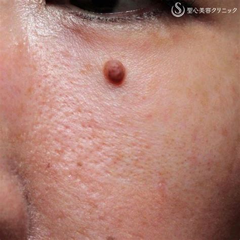 美容皮膚科「ほくろ・イボ」の症例写真｜聖心美容クリニック札幌院