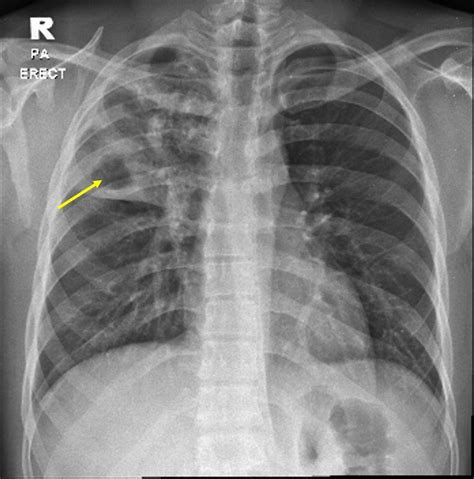 Pulmonary Tuberculosis Radiology Cases