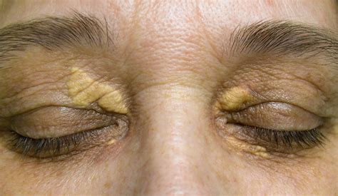 Understanding Xanthelasma Aesthetics