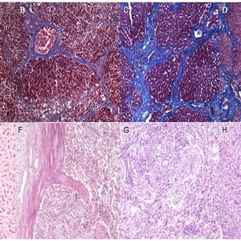 Histology Of Liver Fibrosis Stages And The Corresponding Spleen