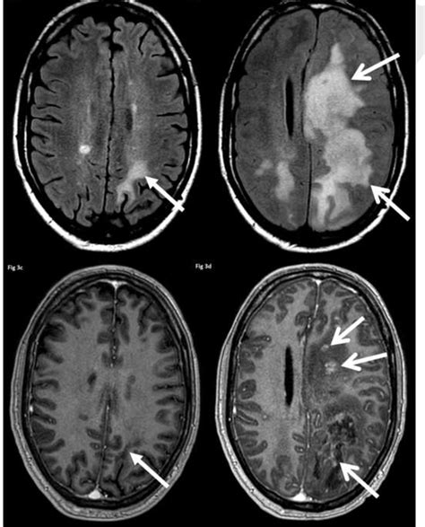 Multiple Sclerosis Mri Ms Mri Asst Multiple Sclerosis Brain