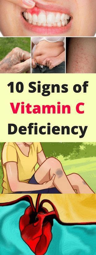 Take Note 10 Signs Of Vitamin C Deficiency Avec Images Remede Aloes