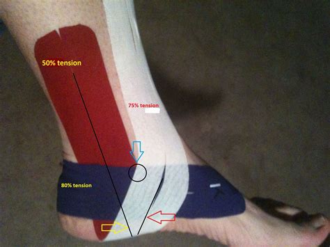 Kt Tape Ankle Placement Tarsal Tunnel Syndrome Kinesio Taping
