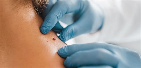 Skin Tag Removal Apderm
