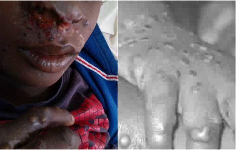 Get the facts on treatment, prevention, prognosis, and diagnosis. Deadly Viral Disease 'Monkeypox' Hits Bayelsa, Medical ...