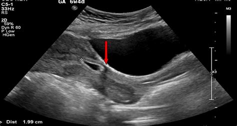 Cureus Cesarean Scar Ectopic Pregnancy A Diagnostic And Management