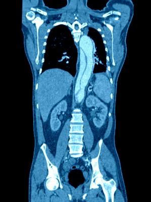 Ct scan was previously known as computerized axial tomography scan or cat scan. IV Contrast for CT Not Associated with Increased Risk of ...