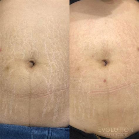 Stretch Mark And Scar Reduction Laser Stretch Mark And Scar Removal Elc