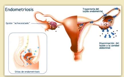 Endometriosis is a condition where tissue similar to the lining of the womb starts to grow in other places, such as the ovaries and fallopian tubes. Ovarian Pain: Possible Causes, Diagnosis, and Treatments | SHL