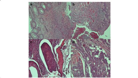 Histopathological Findings A Squamous Cell Carcinoma Invading The Wall