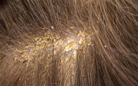 Scabs On The Scalp 10 Causes And Their Treatments Skinkraft