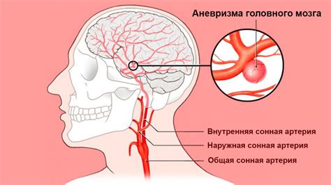 Профилактика аневризмы сосудов головного мозга — Про сосуды