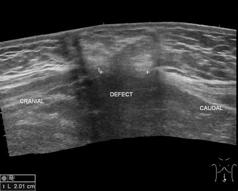 Umbilical Hernia Radiology Case