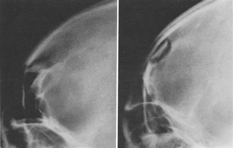 Primary Reconstruction Of Depressed Frontal Skull Fractures Including