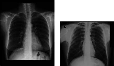 Posteroanterior Pa Chest Radiographs Obtained With Computed