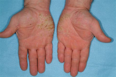 Chronic Hand Dermatitis Case Based Approaches To Management