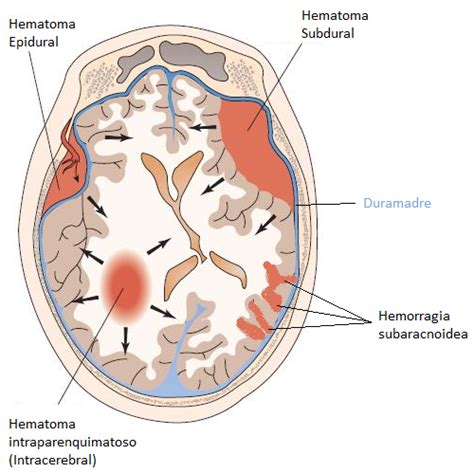 Hemorragia Cerebral Cirug A Neurol Gica Integral De Oriente