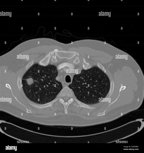 Chest Ct Scan X Ray Computed Tomography Of A Male 54 Year Old Patient