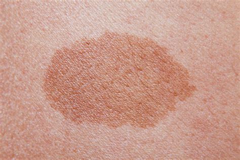 Birthmarks Causes Types And Treatments