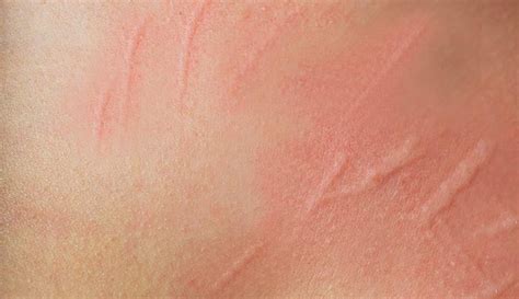 Dermatographia Dermatographism What It Is Causes And Treatment