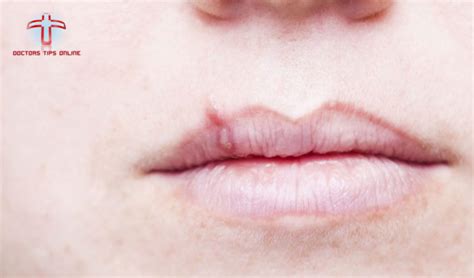 White Bump On Lip Archives Doctors Tips Online