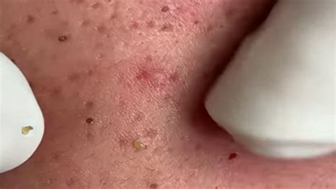 Satisfying Remove Blackheads Acne Removal Blackheads Youtube