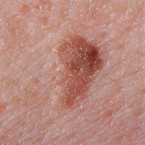 Suspicious Moles And Skin Lesions Consultation