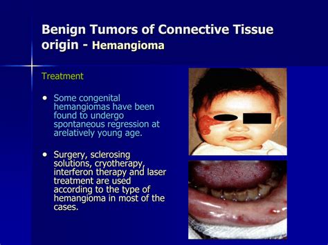 Ppt Benign Tumors Of The Oral Cavity Powerpoint Presentation Free