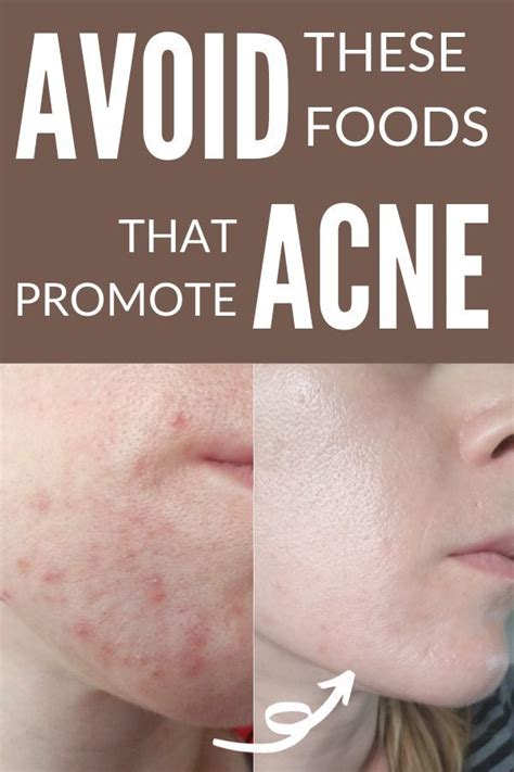 Hormonal Acne Diet Plan Best 7 Day Clear Skin Meal Plan Pdf Acne