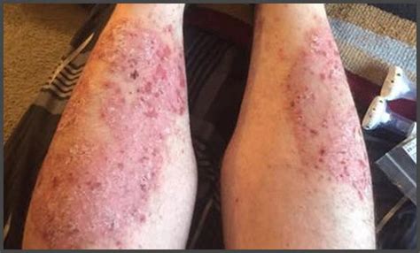Pictures Of Psoriasis On Legs Psoriasis Expert