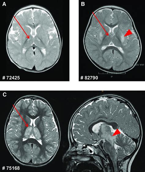 Brain Mri Of Affected Individuals 72425 82790 And 75168 A Mri Of
