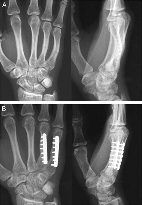 Trapezoid Rotational Bone Graft Osteotomy For Metacarpal And Phalangeal