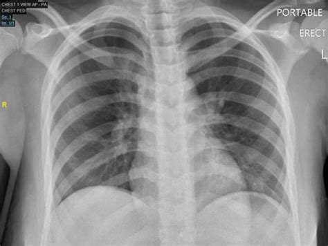 Chest X Ray Pa Showing No Cardiopulmonary Disease Or Free Air Under