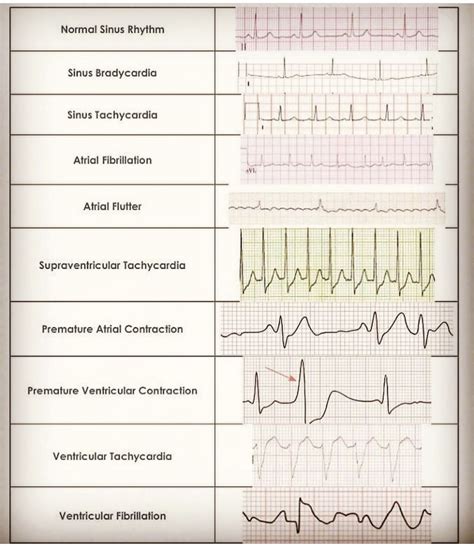 Ekg Practice Worksheet With Answers