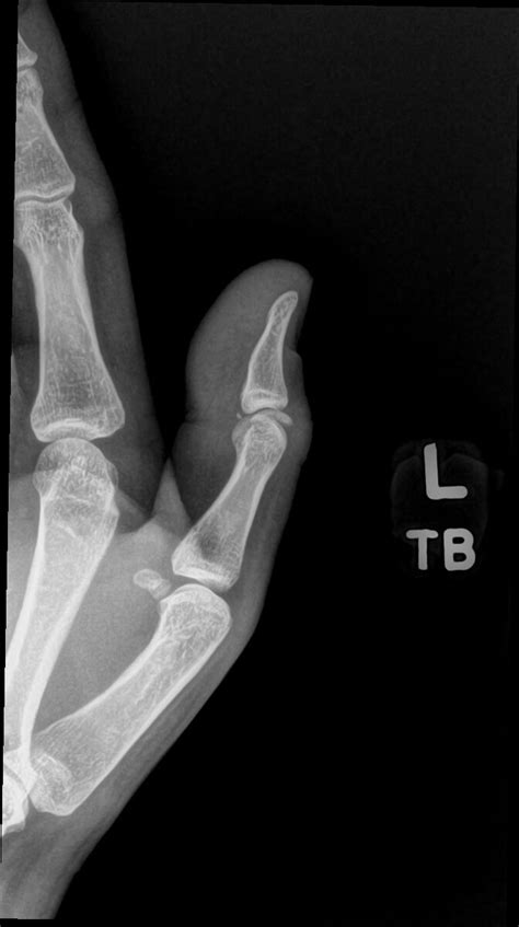 Orthodx Pain In Thumb Clinical Advisor