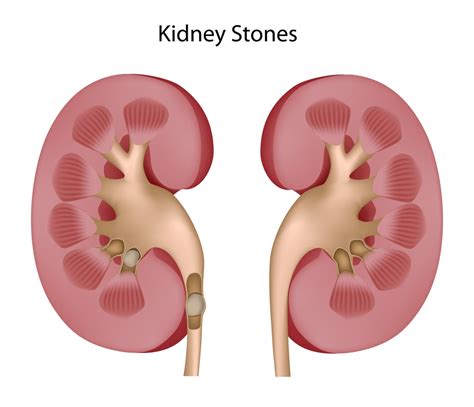 Kidneys With Stones Staffordshire Urology Clinic