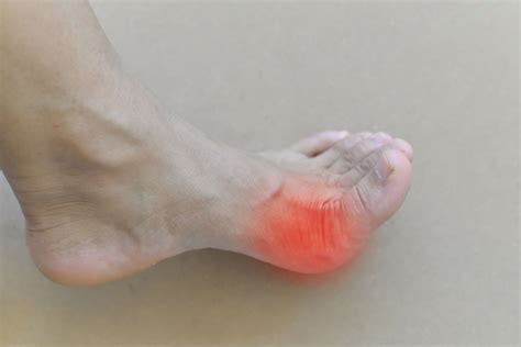 Houston Gout Specialist Red Big Toe Joint Burning Toe Pain Tanglewood