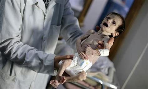 Images Of Emaciated Syrian Child Shocking Un Daily Mail Online