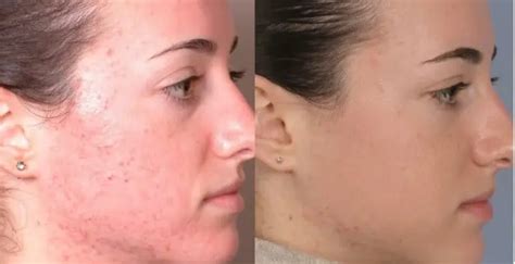 Dermalinfusion Silkpeel Discovery Laser Skin Care Clinic