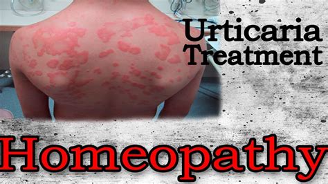 Urticaria Discussion And Treatment In Homeopathy By Dr Ps Tiwari