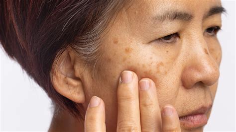 10 Common Skin Conditions