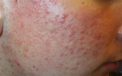 Acne Types In Pictures Explanations And Treatments