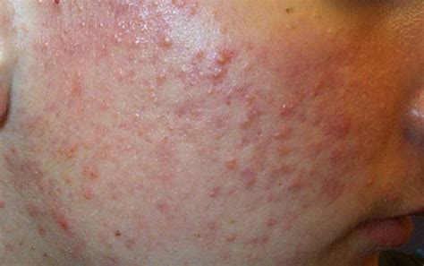 acne types in pictures explanations and treatments