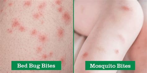 Bed Bug Vs Mosquito Bites Green Pest Solutions