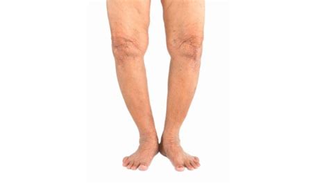 11 Easy Bow Leg Exercise To Fix Genu Varum Knee