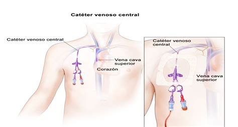 Catéter venoso central CVC Catéter venoso central Cateter Cavidades del cuerpo