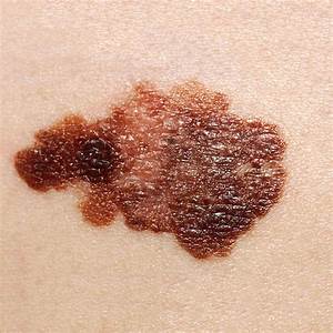 Spot the Differences Between a Mole and Skin Cancer Skin Cancer  