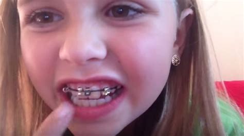 Experts Warn Teens Diy Braces Trend Can Ruin Teeth Kutv